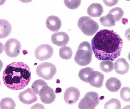 Oncología y Oncohematología